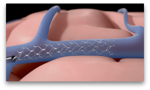 stent rod can replace open brain surgeries